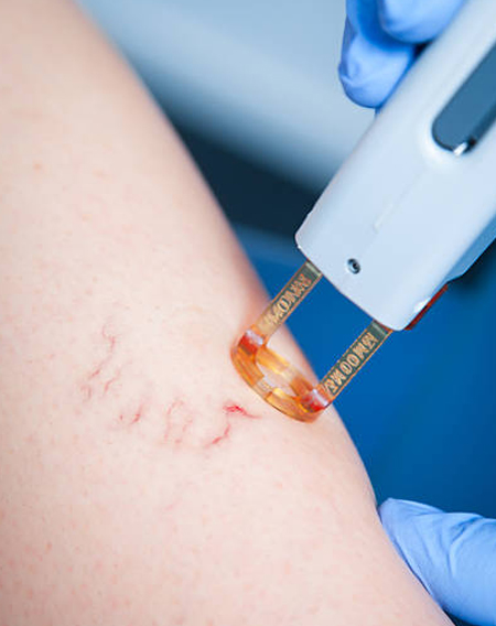 Types of Cosmetic Laser Procedures