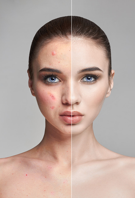 RF Microneedling in Queensland