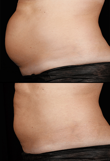 Sculpsure Sydney Body Contouring